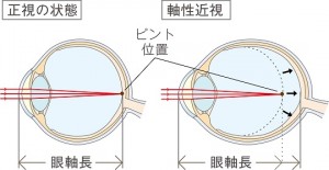 マイオピン眼軸