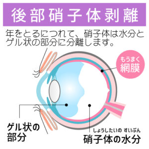 後部硝子体剥離