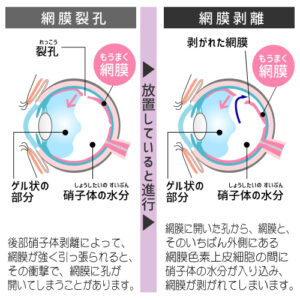 網膜裂孔と網膜剥離
