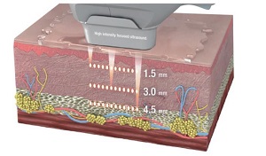 HIFE照射皮膚断面