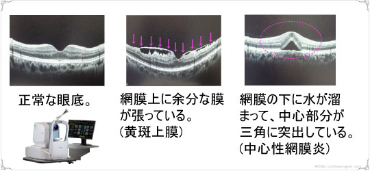 OCT解析