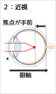 近視