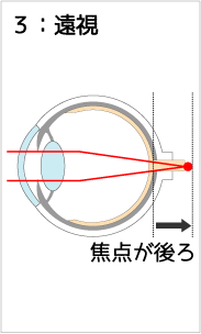 遠視