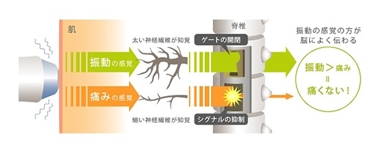 サーマクールCPT痛み